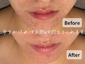 バタフライ 平塚店(Butterfly)/消えなかった茶色い跡が綺麗に