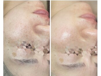 シーカラー 中野栄店(C.color)/陶肌ピールで爆艶・美白・透明感