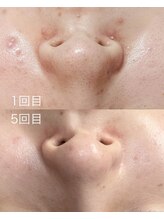 マテリアル(Material`)/REVI(ルヴィ) ハーブピーリング