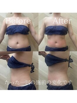 介正鍼灸整骨院 整体院 エフコープ大野城店/痩身エステ／ビフォーアフター