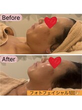 リヒト(LiHiTO)/光フェイシャル★１回