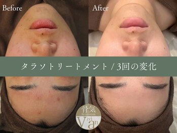 ヴィヴィアン 名駅店(骨気&Relaxation Vivian)/タラソトリートメント