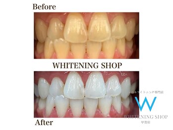ホワイトニングショップ 甲賀店/Before&After『ホワイトニング』
