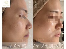 サロンドレナ 名駅店/ハーブピーリング サロンドレナ