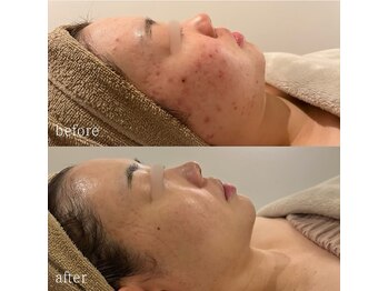 ニコリー(NICOLY)/赤ニキビケア症例【施術12回目】