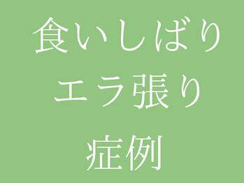 ビープラス(BEE PLUS)/食いしばりによるエラ張り