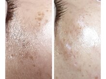 光フェイシャル【フォト】！シミケアし放題メニューにて