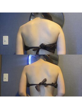 優来 神田店/肩甲骨施術の例