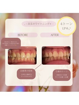 プラスビーセルフ(+b self)/ホワイトニングビフォーアフター