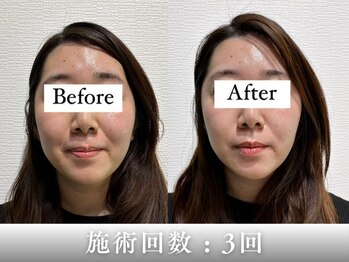 フラット(flat)の写真/むくみ・食いしばり・もたつきに◎美顔器「セルキュア」×電気を流す小顔美容鍼で即すっきり | 初回 7200円