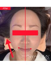 カリオン/最新マシンでお顔引き上げ