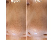 アリュール(Allule)/毛穴改善