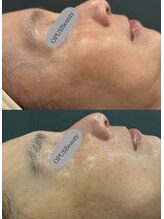 オーパス ビューティー(OPUS Beauty)/マーメイドセルトリートメント