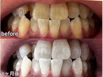 グラーティア 奈良王寺店/ホワイトニング★6ヶ月目★