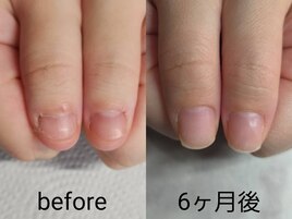 深爪矯正、その後