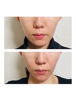 ヨサパーク エルメ 経堂(YOSA PARK Herme)/ルルオンで小顔になれる！