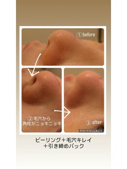 フェローズリンパケア(FELLOWS)/オイリースキン、角栓つまりに