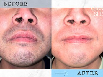 ラッシュ(RUSH)/出張の合間に3ヵ月に1回で完了!