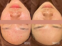 ウォーム(warm)/ニキビケア/肌荒れ/ニキビ肌