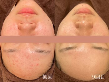 ウォーム(warm)/ニキビケア/肌荒れ/ニキビ肌