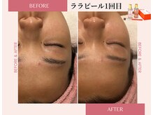 ラシック(La chic)/毛穴洗浄/ララピール心斎橋大阪