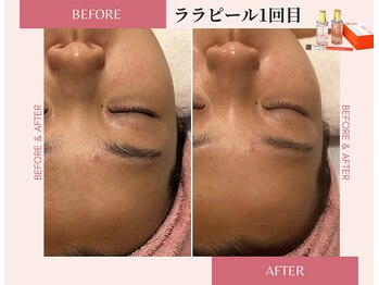 ラシック(La chic)/毛穴洗浄/ララピール心斎橋大阪