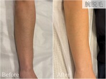 ケリーズ(KELLY `S)/腕脱毛/熊本