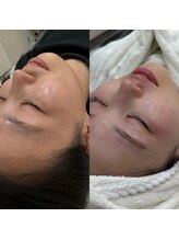 ビオラス(VIOLUS)/20代のお客様/フェイスワックス