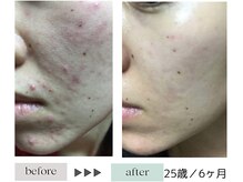 ハイケア グラン ギンザ(HYCARE GRAND GINZA)/日本ーの肌改善サロン実力/銀座