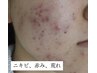 【ニキビ改善対策】お肌の土台から整えるプラズマニア施術でつるんとツヤ肌へ