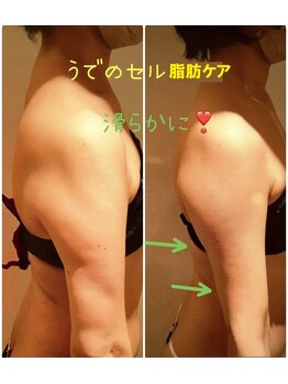 ビューティースパ/【7回】二の腕凸凹セル脂肪撃退!