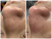 ルクシア(RUXCIA)/ビフォーアフター/毛穴洗浄1回