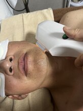 フーレスト アンド フリーリー(Fullest&Freely)/ヒゲ脱毛