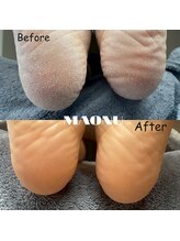 マオヌー(MAONU)/韓国式足裏角質ケア　症例写真