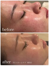 ブリス(BLiSS)/ニキビの赤み改善