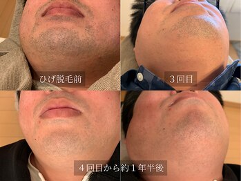 アルム(Arum)/ひげ脱毛