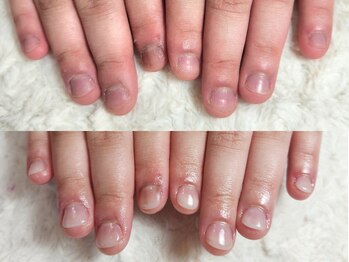 グラシナ なんば店/深爪/自爪育成/フィルイン