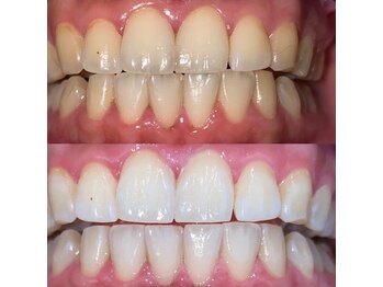 ホワイトニングビューティー 松戸店(Whitening Beauty)/ビフォーアフター