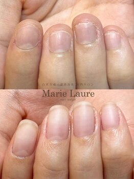 マリーロール 梅田店(Marie Laure)/自爪育成/深爪矯正/ネイルケア