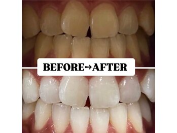 ホワイトニングサロン 豊中/Before&After美白ホワイトニング