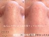 SNS話題！≪韓国式毛穴洗浄＋フェイシャルワックス≫産毛¥23,660→¥15,680