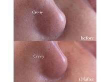 クレヴィー(Creviy)/潤艶wax脱毛(産毛脱毛)1回施術