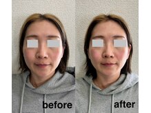 ワイ(Y)/伸びたお顔の長さも短縮！！