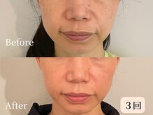 ロシュニ/40代 お悩み:たるみ(ほうれい線)