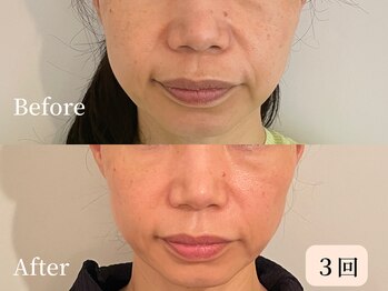 ロシュニ/40代 お悩み:たるみ(ほうれい線)