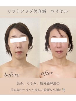 めい鍼灸院/たるみ・歪み・疲れ顔・シワ改善