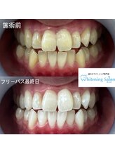 ホワイトニングサロン 熊本店/いつでもセルフホワイトニング