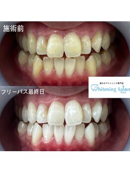 ホワイトニングサロン 熊本店/いつでもセルフホワイトニング