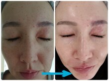 アズ(AZU)/40代before after