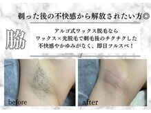 アルゴ 熊本八代店(ALGO)/【脇】不快感や痒みからの解放☆